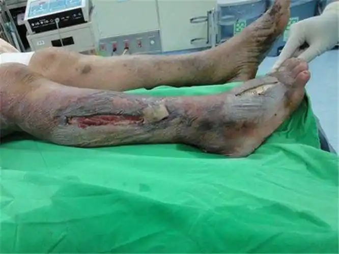 儿童腿部坏死性筋膜炎图片_有来医生