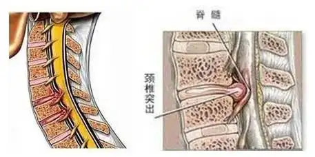 小颈椎引起大麻烦颈椎间盘突出病因症状你了解吗