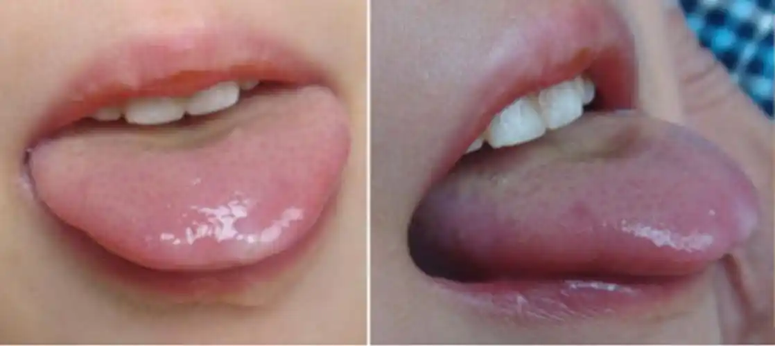 手足口病初期舌头图片