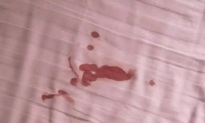 24岁女生底裤脏兮兮,被查出感染hpv病毒,医生:要爱惜自己的身体