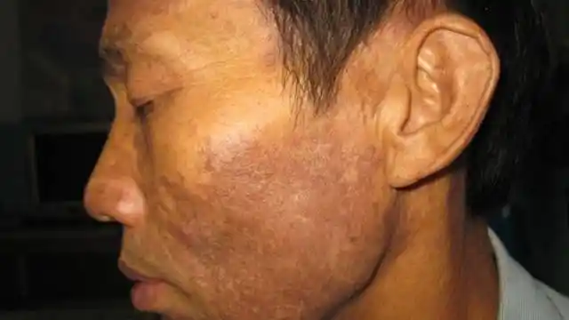 哑光一样的灰色,这已经不是早期肝炎的症状了,很可能是重症肝病的症状