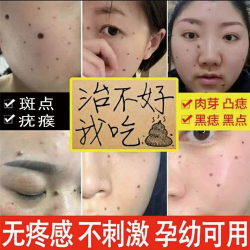 去脸上的黑志点斑去痣点痣膏脸部专用除志去黑痣祛痣无痕正品神器