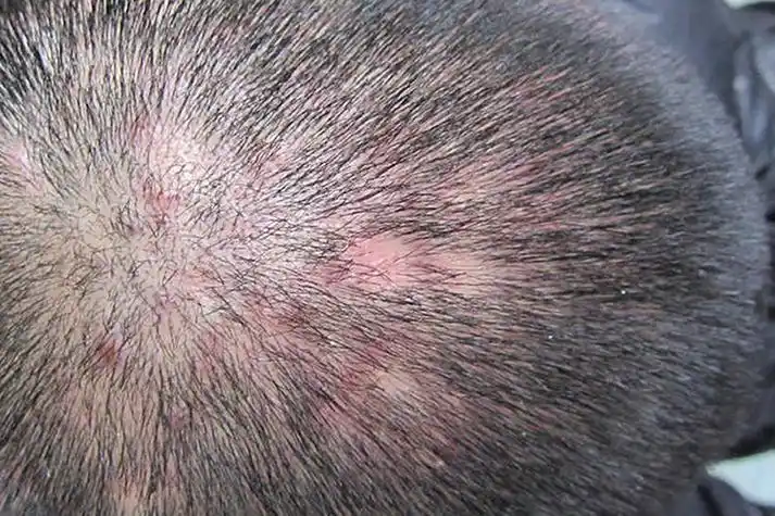 头皮部脱发性毛囊炎图
