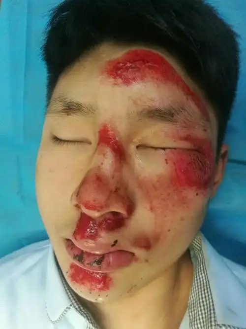 7床 张孝起 男 17岁诊断:面部外伤 面部多出皮肤挫伤