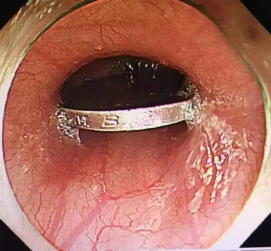 擒拿食管异物的妙手神探