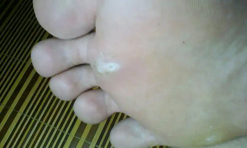 我的脚底好疼,像是起了个白的包,用剪刀稍微剪开