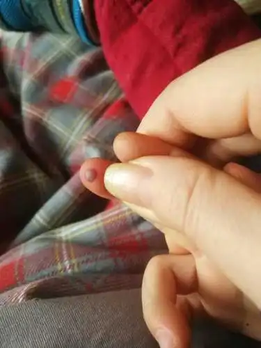 三岁宝宝摔跤手指摔了一个血泡,应该怎样处置?