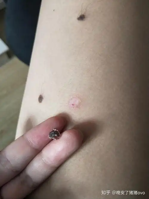 治寻常疣花掉了1000元这正常吗