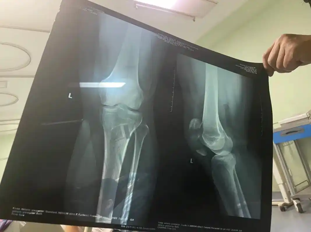 骨折手术 #髌骨骨折 #生日快乐 #难熬 - 抖音