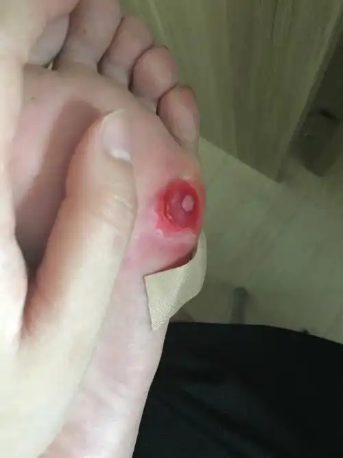 贴了10多天鸡眼贴了,现在这个情况特别疼,该如何处理呢