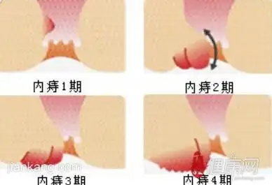内痔疮图片的有关介绍