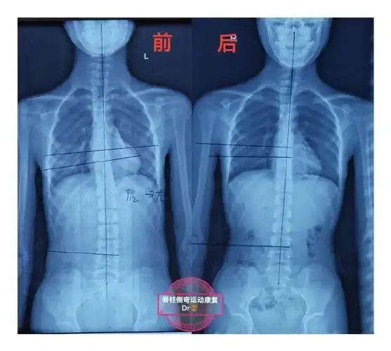 暑假将至第四期脊柱侧弯训练营即将开营