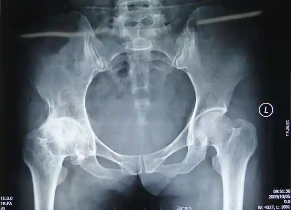 髋关节骨性关节炎人工全髋关节置换