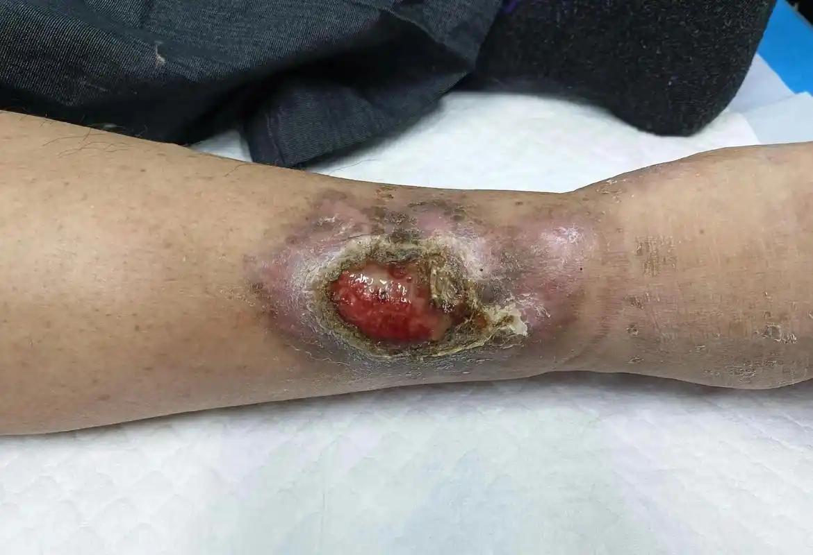 烧伤后创面不愈合,两种治疗方案,一是 - 抖音