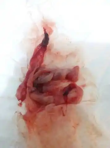 今天下午流出来了,是这个,是不是孕囊?现在肚子也不痛了,出血也减少了