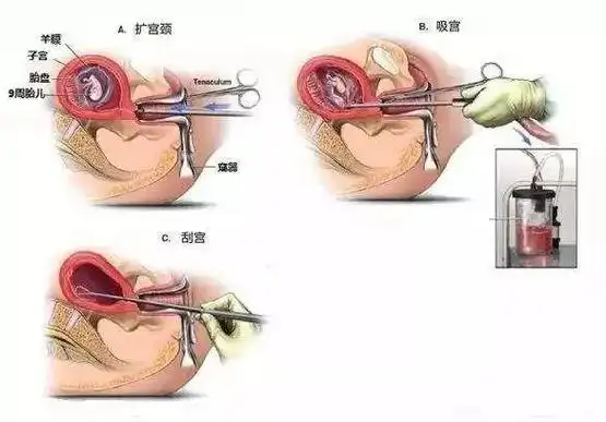 无痛人流你只是睡一觉,却不知道子宫经历了什么!