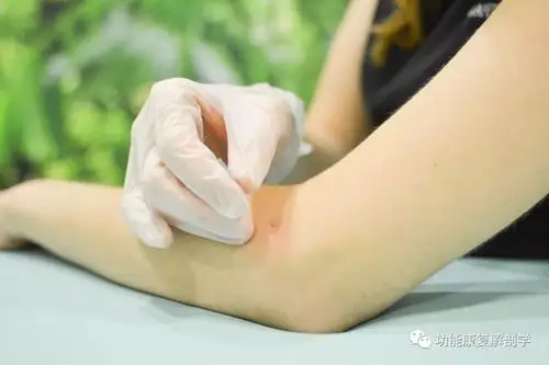 肱骨外上踝炎网球肘如何进行物理治疗