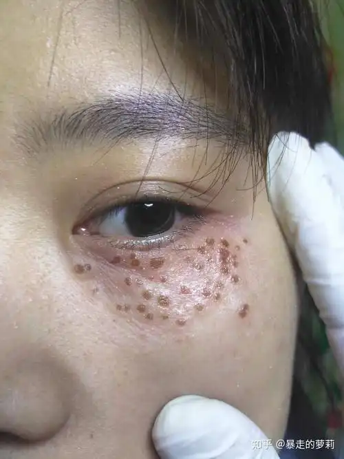 汗管瘤治疗第一天