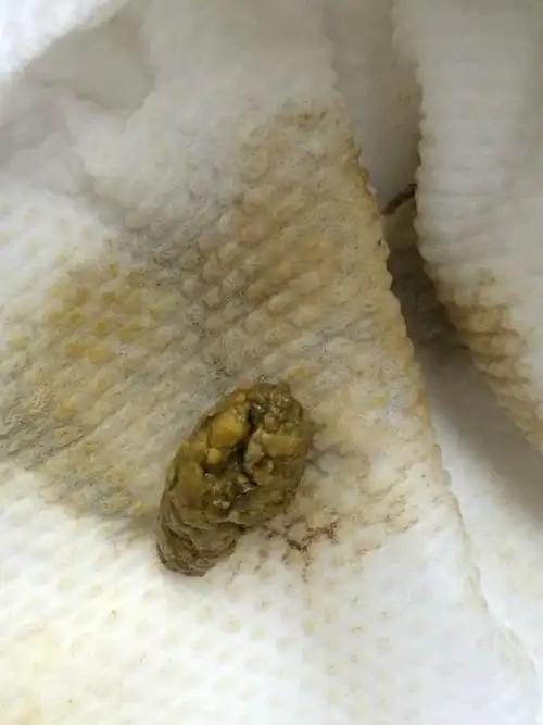 大便成条状的 是正常的吗?