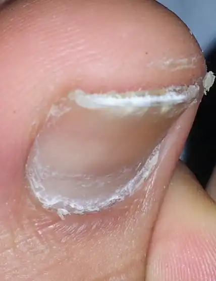 脚 指甲 变厚,有点疼.是不是有问题?