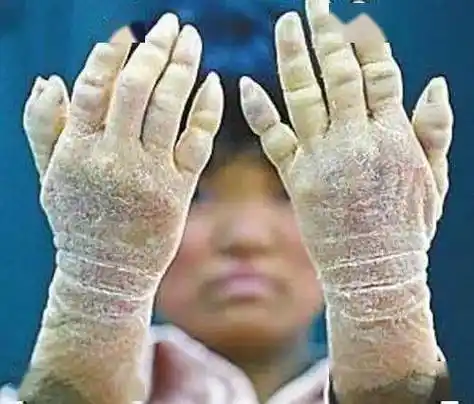 高血糖来报道前,身体3个部位会发出"信号灯",劝你多留意!