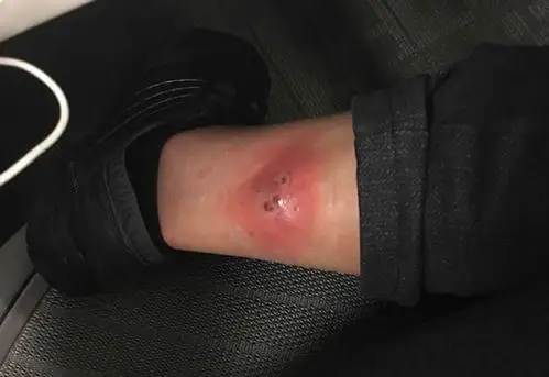 这女子被蜘蛛狠咬后"素食改肉食",结果变健康了