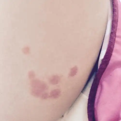 大腿内侧这些红斑是什么?