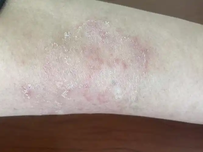 体癣_介绍_症状表现 - 好大夫在线