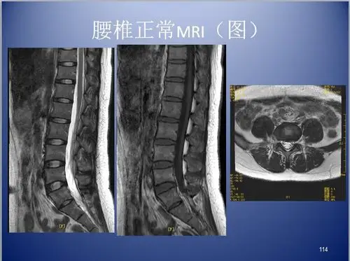 脊柱ct,mr断层解剖2