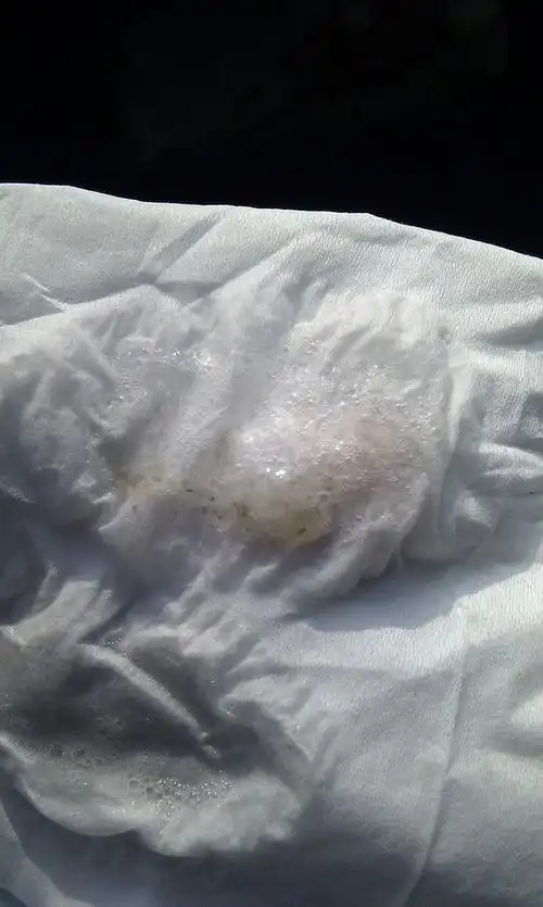 已戒烟两年,因为咳出浓痰有鹌鹑蛋一半大了,中间带黑色,黄色的丝状