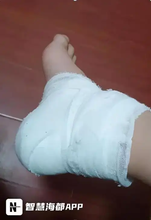 突然感觉石块有些松动,于是赶紧让开,但还是被掉下的石块砸到了脚后跟