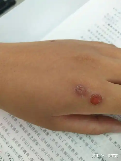 寻常疣冷冻治疗记录