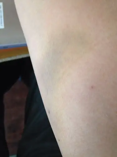 献过血1星期了,手臂为什么呈淤青色