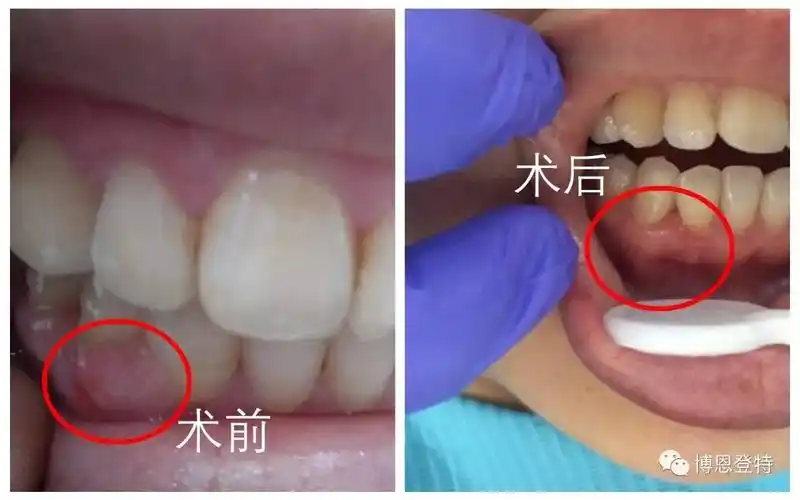 激光牙龈肿了也许是牙龈瘤