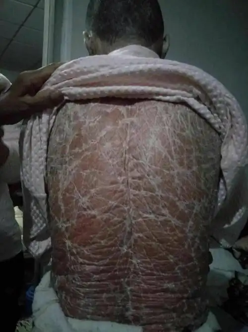 35年的牛皮癣得到恢复