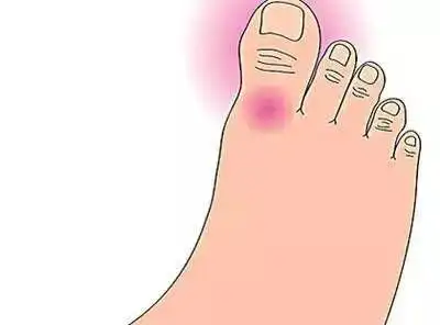 高尿酸血症是痛风的发病基础,因为大脚趾位于人体的最下端,表面温度低