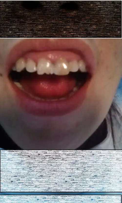 我这种四环素牙,灰灰的,用什么方式美白?要上层白颜色的牙釉质吗?