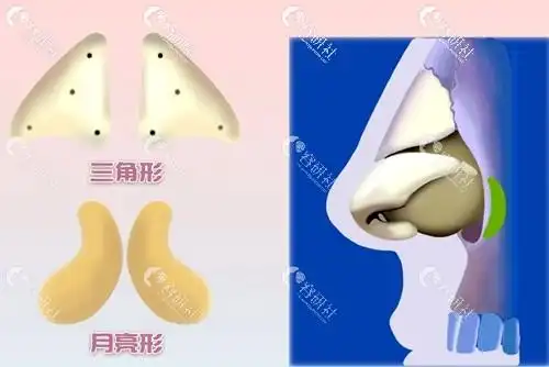 三角形和月亮形假体垫鼻基底示意图