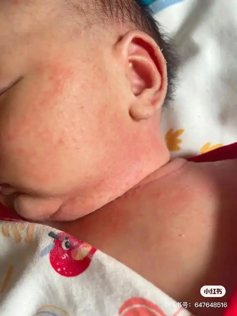 宝宝热疹怎么办?来广东后宝宝就起热疹了,本来是脸,反反复复的 - 抖音