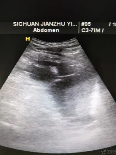 超声胃内条索状中强回声