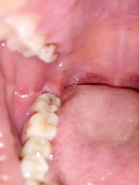 牙龈肿了个肉坨怎么办多久会好(牙龈发炎肿痛怎么办) 服务器教程 第1