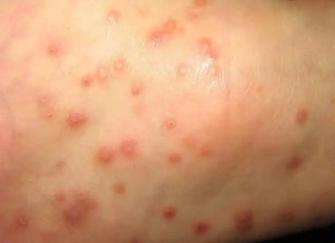 皮肤病图片对照大全症状