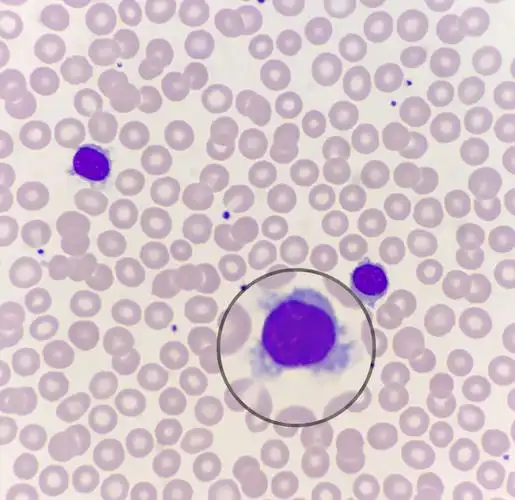 一例由外周血涂片辨识出的毛白