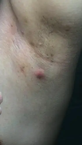 腋下这个是毛囊炎还是淋巴结肿大?有图