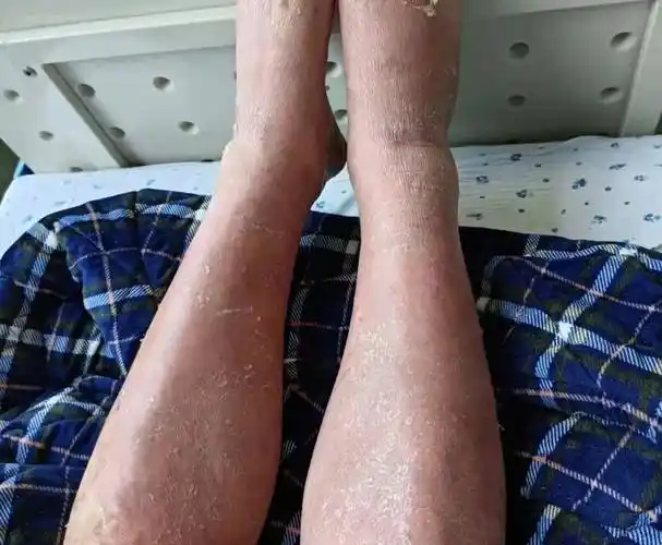 我院皮肤科成功医治一例重症红皮病型银屑病_患者_治疗_李先生