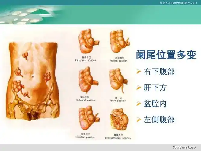 com 阑尾位置多变 ¾右下腹部¾肝下方¾盆腔内¾