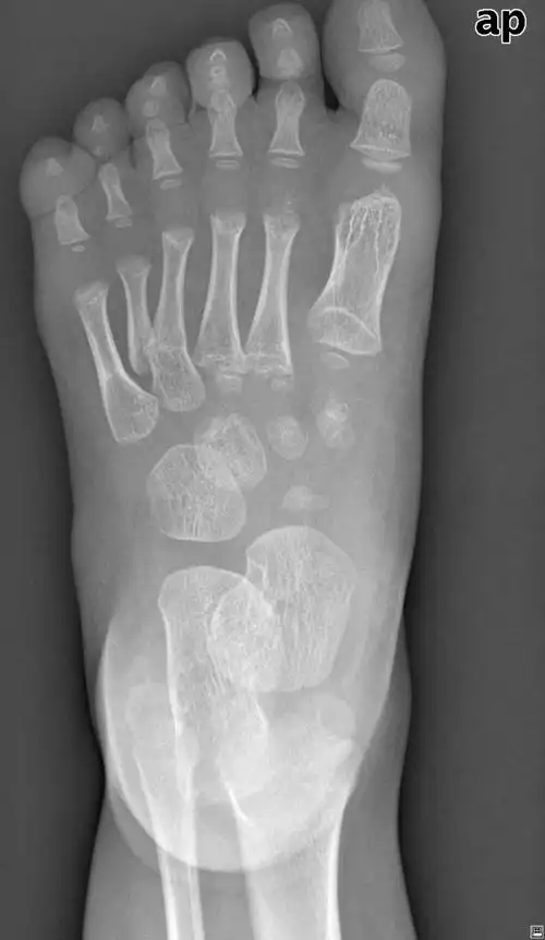 先天性左足第五趾多趾畸形的矫治