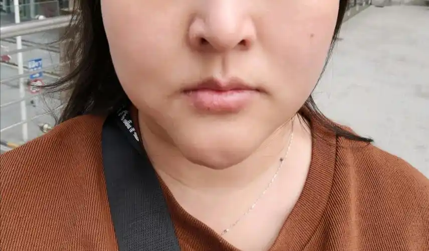 我是下巴疤痕增生有十二年了,有做医美的朋友建议我打_圈子-新氧美容