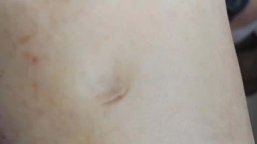 两条腿都有一条肿,按下去有个小坑,过一会才能鼓起来,什么引起的