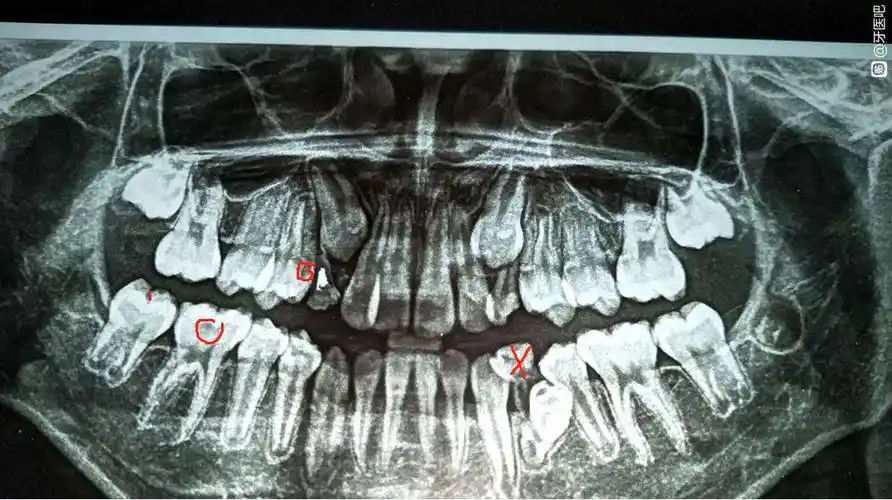 牙片怎么看龋齿? - 知乎